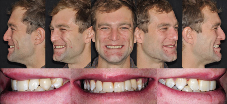 Dental Implants